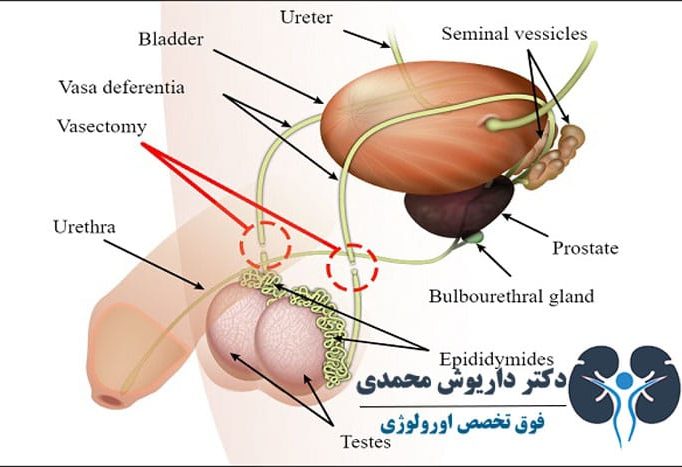 vasovasostomy