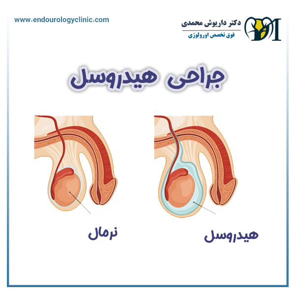 جراحی هیدروسل در تهران - دکتر داریوش محمدی