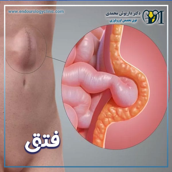 فتق + دکتر داریوش محمدی