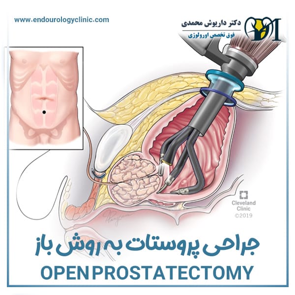 جراحی پروستات به روش باز + دکتر داریوش محمدی