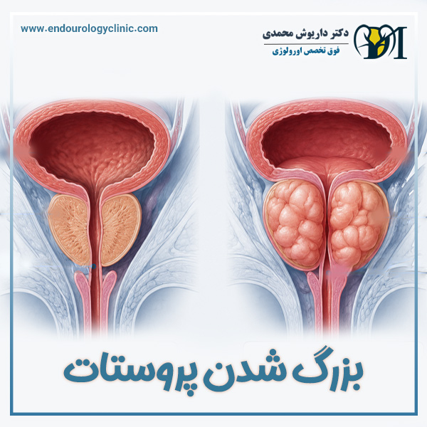 بزرگ شدن پروستات + دکتر داریوش محمدی