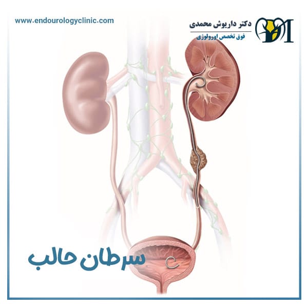 سرطان حالب + دکتر داریوش محمدی