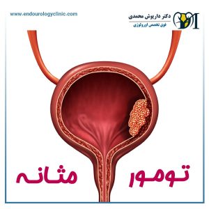 تومور مثانه - دکتر داریوش محمدی