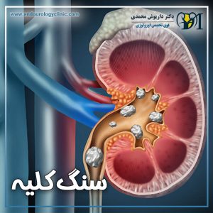 سنگ کلیه - دکتر داریوش محمدی