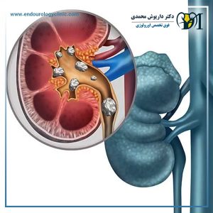 سنگ کلیه - دکتر داریوش محمدی