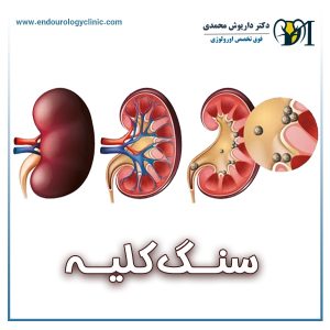 سنگ کلیه - دکتر داریوش محمدی