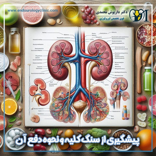 پیشگیری از سنگ کلیه - دکتر داریوش محمدی