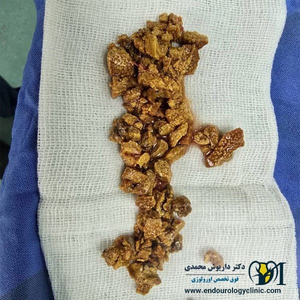 عکس سنگ کلیه جراحی شده توسط دکتر داریوش محمدی