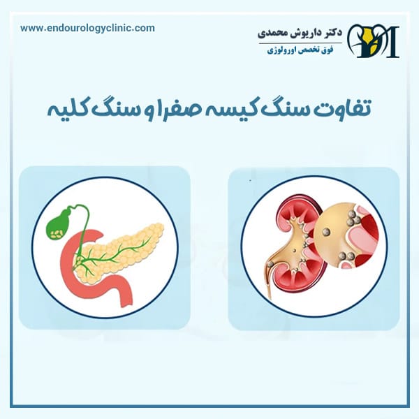 تفاوت سنگ کیسه صفرا و سنگ کلیه + دکتر داریوش محمدی