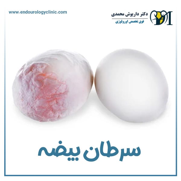 سرطان بیضه + دکتر داریوش محمدی