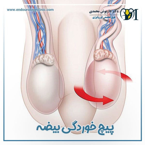 پیچ خوردگی بیضه + دکتر داریوش محمدی