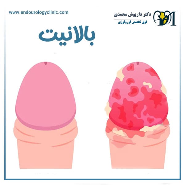 بالانیت + دکتر داریوش محمدی