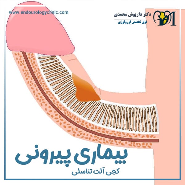 بیماری پیرونی + دکتر داریوش محمدی