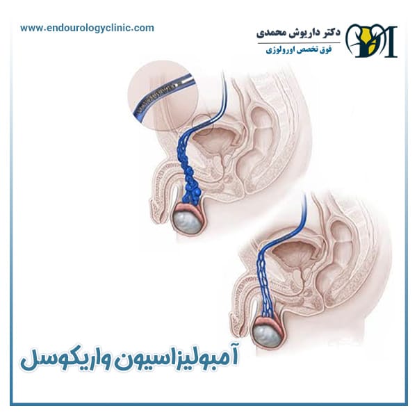 آمبولیزاسیون واریکوسل + دکتر داریوش محمدی